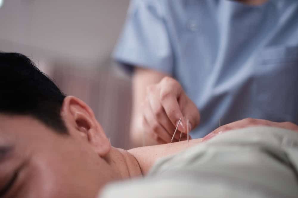 A close-up of a patient receiving acupuncture treatment, with a practitioner’s hand carefully inserting thin needles into the person's upper back